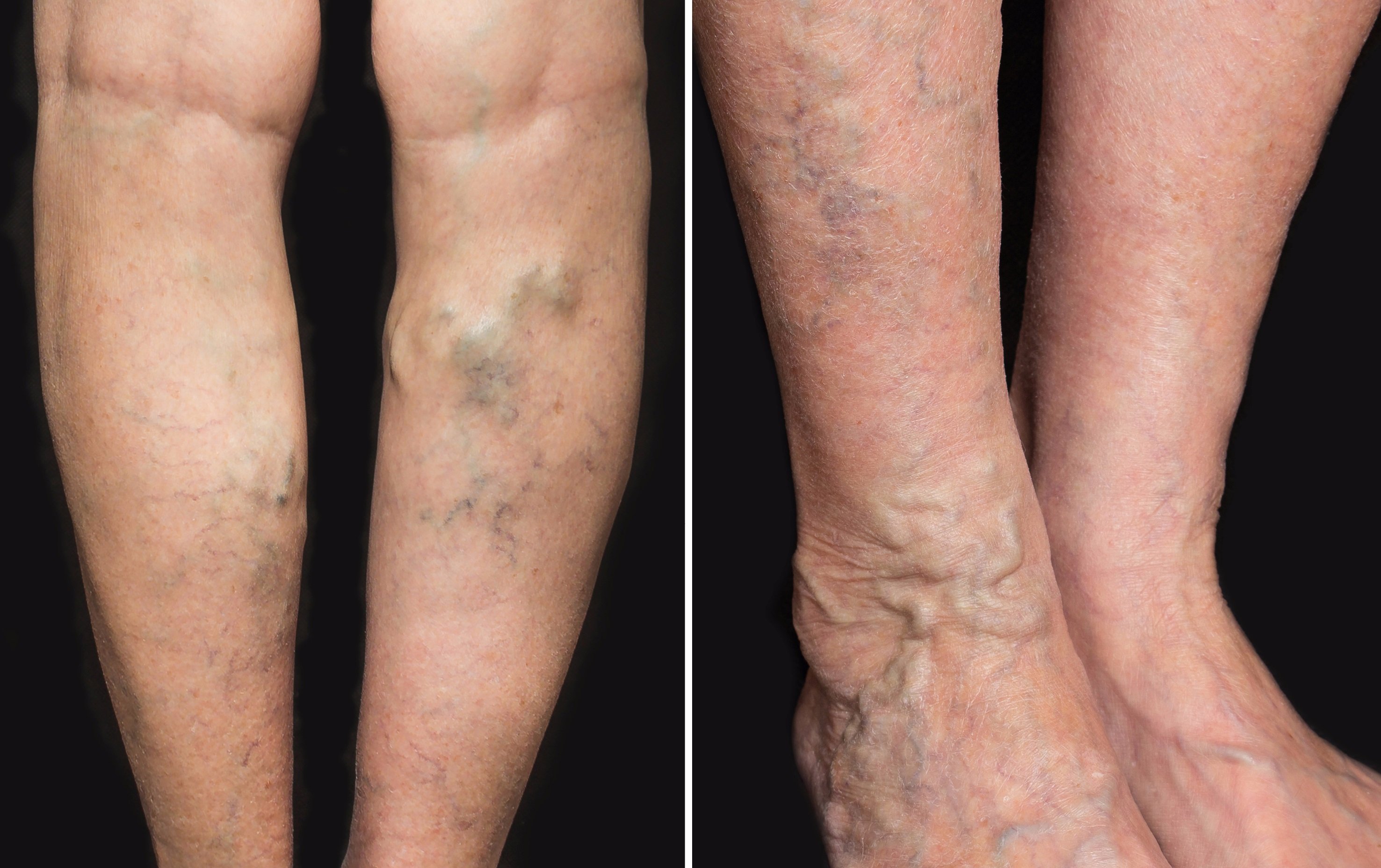 Ierburi utilizate pentru tratamentul varicelor - Ierburi din varice pe picioare - Simptome