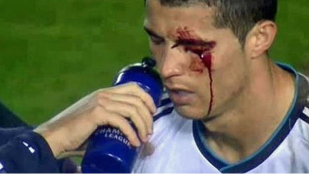 Fotbalul, sport sângeros. Cele mai dureroase accidentări din fotbalul mondial
