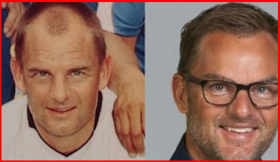 Fotbaliștii care și-au făcut implant de păr. Ștefan Radu și Walter Zenga, în top