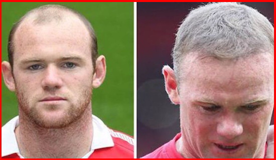 Fotbaliștii care și-au făcut implant de păr. Ștefan Radu și Walter Zenga, în top