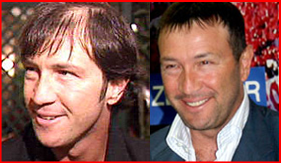 Fotbaliștii care și-au făcut implant de păr. Ștefan Radu și Walter Zenga, în top