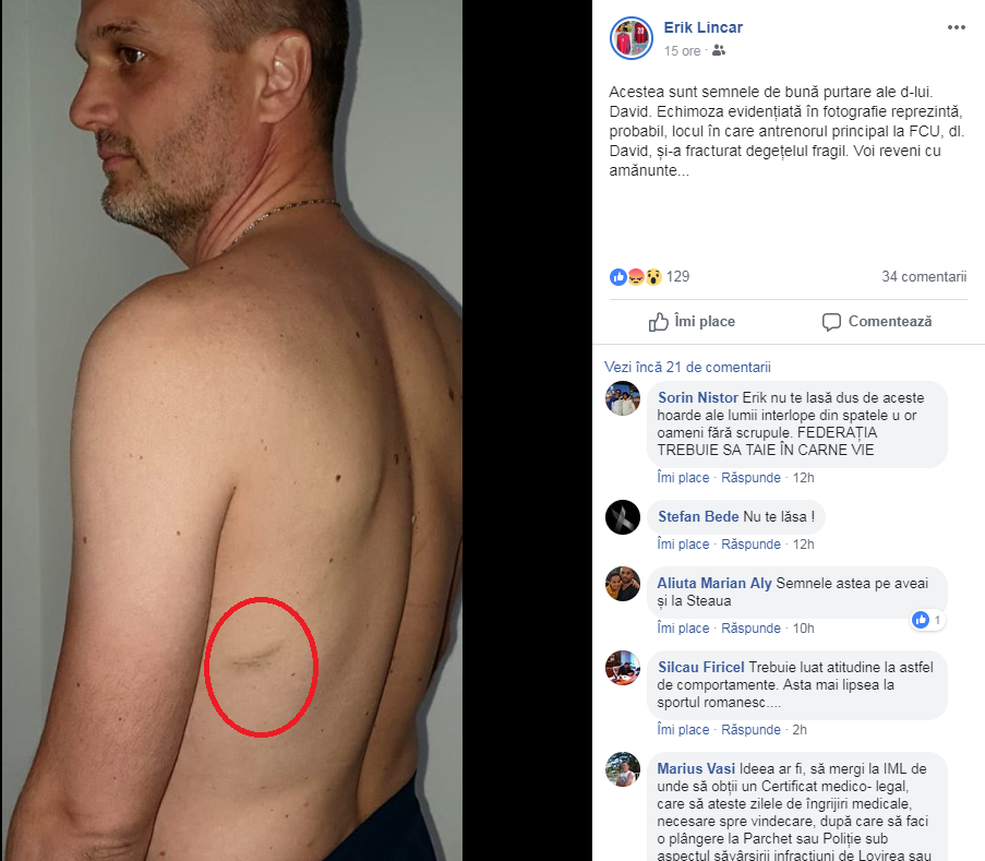 Conflictul dintre Erik Lincar și FC U Craiova continuă. Valentin David susține că antrenorul lui Turris i-a rupt degetul. Lincar își arată echimoza