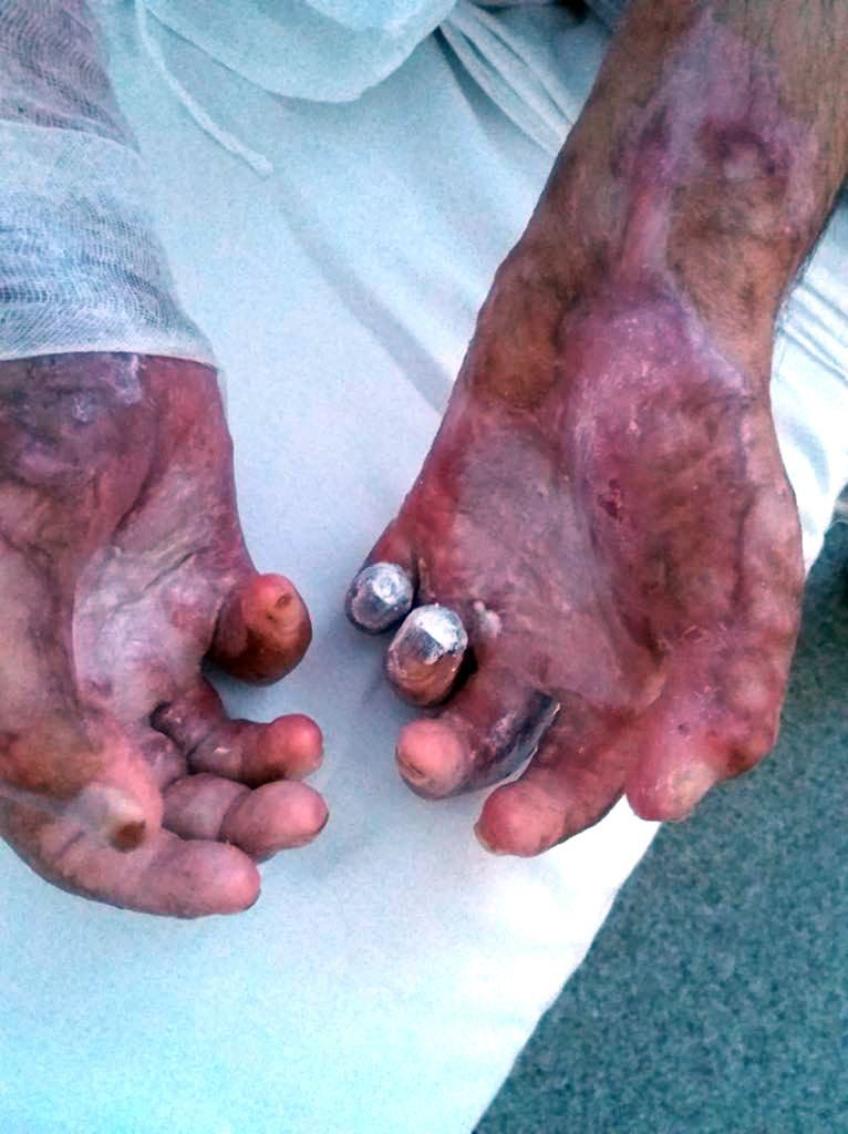 I-au tăiat două degete pompierului din Mehedinți ars în misiune, din cauza infecțiilor. Soția lui: „Dacă nu plecam pe cont propriu, Mihai rămânea fără o mână”