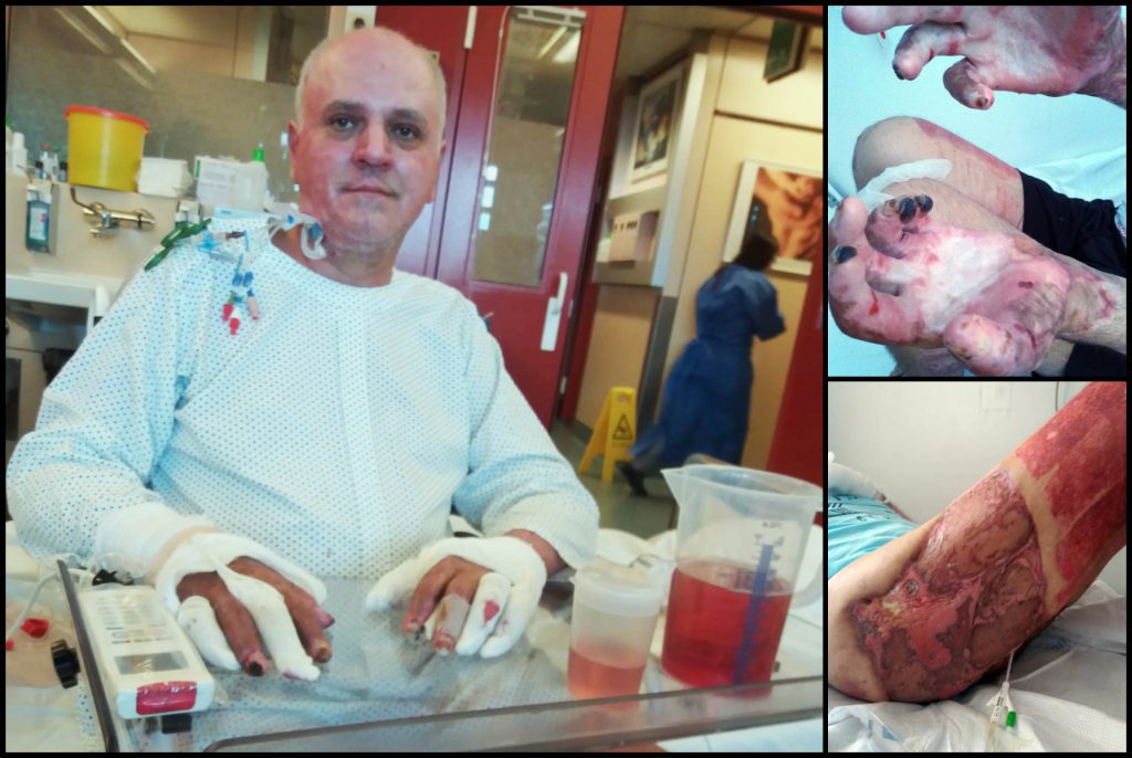 I-au tăiat două degete pompierului din Mehedinți ars în misiune, din cauza infecțiilor. Soția lui: „Dacă nu plecam pe cont propriu, Mihai rămânea fără o mână”