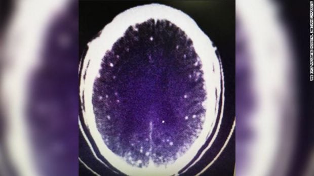Oamenii de știință au descoperit, pentru prima dată, o legătură directă între nivelul scăzut de serotonină și depresie