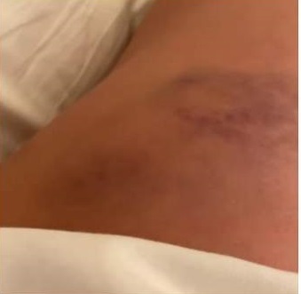 Gina Pistol a căzut și s-a umplut de vânătăi. “Eu încă nu mi-am revenit. Bine că nu am căzut pe burtă”