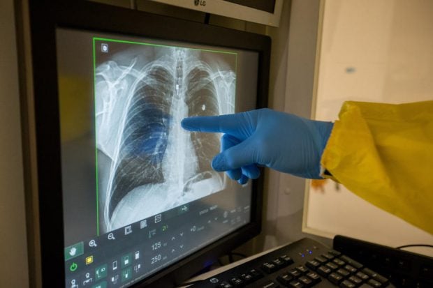 Urmări pe termen lung ale COVID-19: Plămânii infectați arată mai rău decât ai celor mai înrăiți fumători
