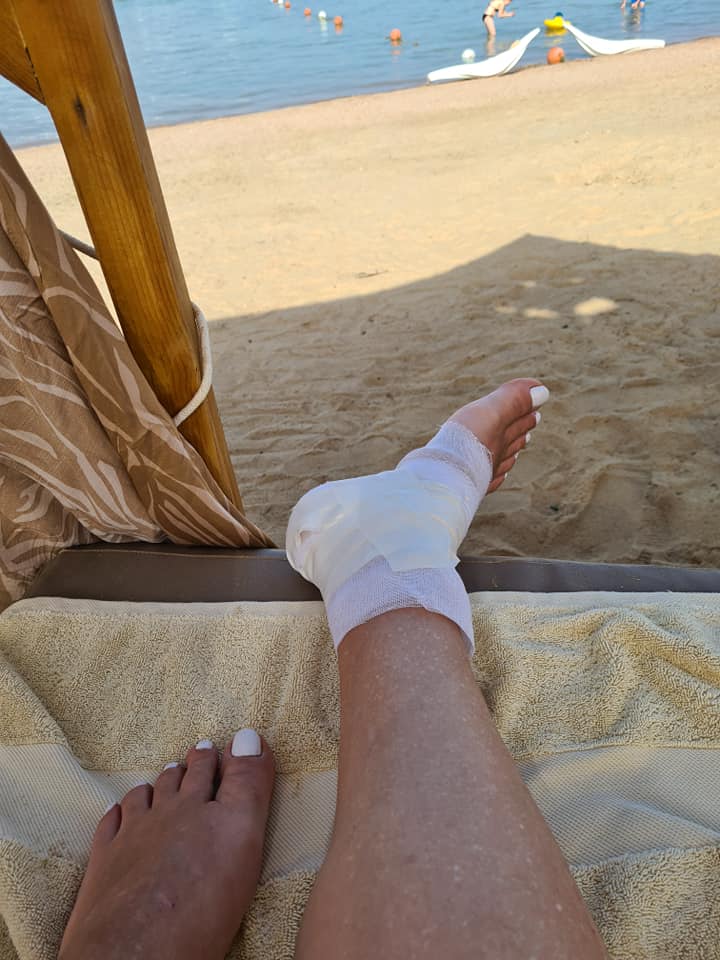 Oana Roman s-a accidentat la picior în ultima zi de vacanță. „Am cinci copci”