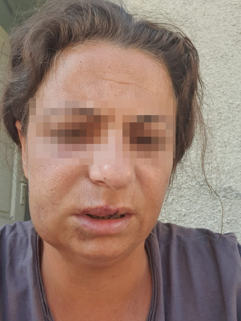 „Legea nu prevede ca polițistul să păzească victima 24 din 24”. Răspunsul Poliției după ce o femeie e bătută repetat de soț