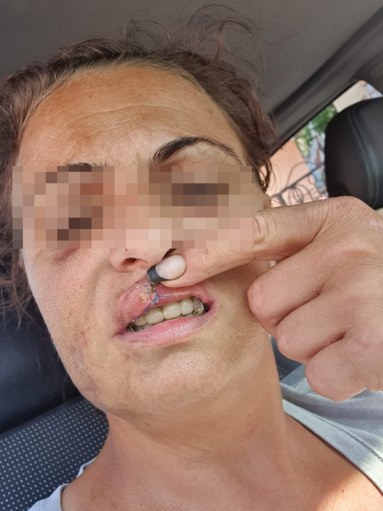 „Legea nu prevede ca polițistul să păzească victima 24 din 24”. Răspunsul Poliției după ce o femeie e bătută repetat de soț