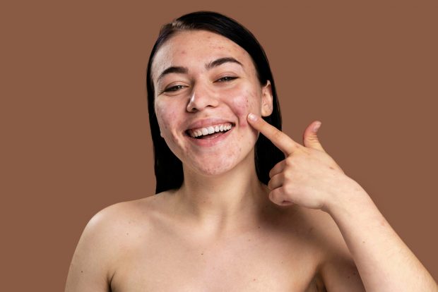 Totul despre acnee: cauze, simptome, tipuri, diagnostic, prevenție, tratament