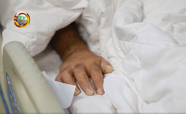 Povestea primului pacient COVID salvat cu un plămân artificial, la Timișoara: un bărbat cu 13 copii, care nu credea în existența virusului