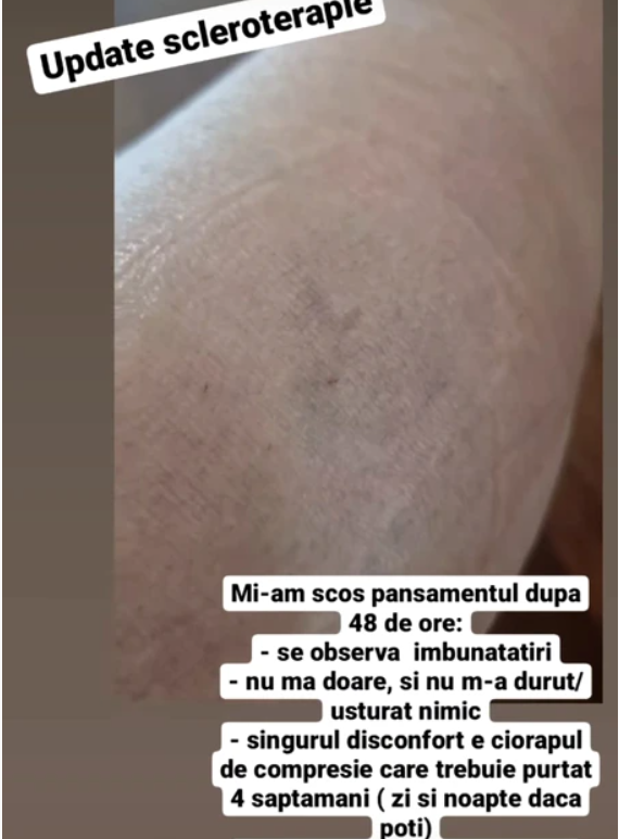 Carmen Brumă a suferit o nouă intervenție din cauza varicelor. Cum arată picioarele vedetei. „Mi-am scos pansamentul după 48 de ore”