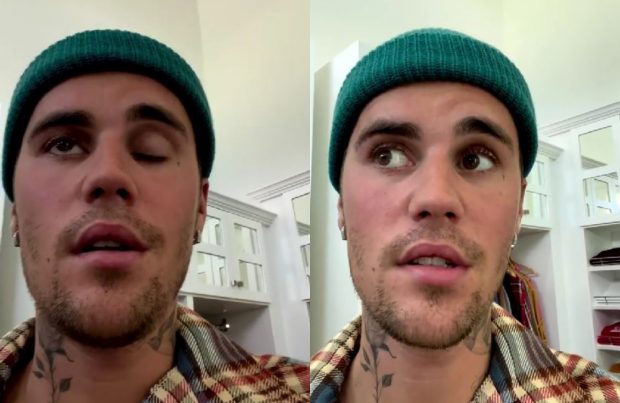 Justin Bieber a anunțat că are paralizie facială din cauza sindromului Ramsay Hunt: „Este destul de grav”