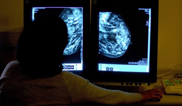 O formă agresivă de cancer de sân afectează mai mult femeile de culoare – Studiu