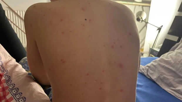 Epidemie de varicelă în județul Alba: Numărul cazurilor a explodat în luna noiembrie