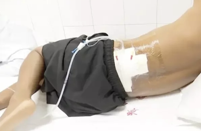 Chinezul care a supraviețuit miraculos, după ce a fost lovit de fulger de două ori în 5 minute