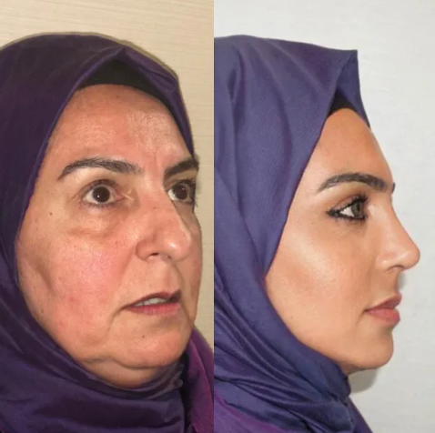 Fotografiile „înainte și după” distribuite de o clinică de chirurgie plastică din Turcia au împărțit internetul: „Dacă e real, vrem lista de prețuri”