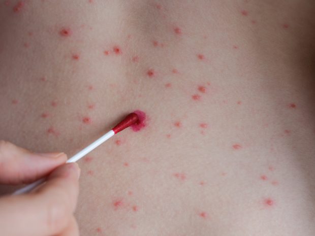 Primul deces de la declararea epidemiei de rujeolă în România: un bebeluș de 7 luni, care a luat boala de la fratele lui nevaccinat