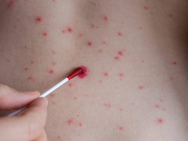 Al patrulea deces în România din cauza rujeolei: un copil de 1 an, din Giurgiu, nevaccinat şi cu mai multe comorbidităţi