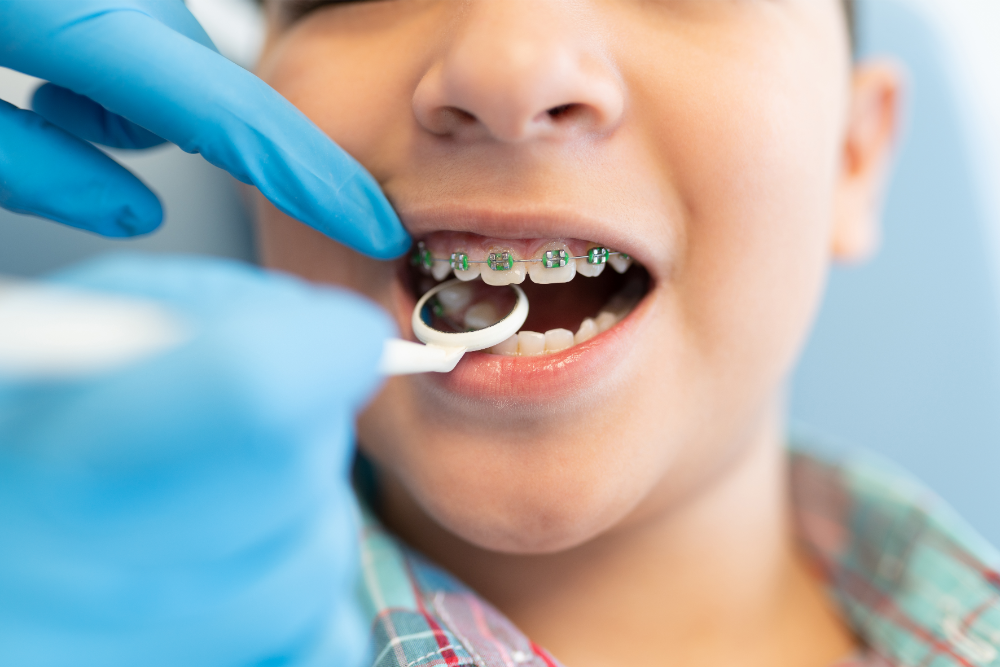 Noutăți în Tratamentul Dentar pentru Copii: Aparatul Dentar în Focus Noutăți în Tratamentul Dentar pentru Copii: Aparatul Dentar în Focus