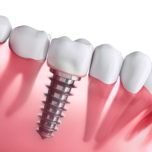 Restaurarea Zâmbetului Perfect cu Implanturile Dentare de la Stomestet Cluj