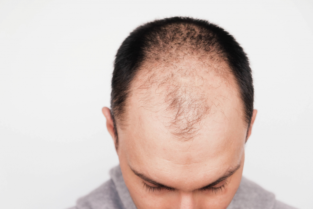 Alopecia - factori de risc, cauze și tratament. De ce chelesc bărbații