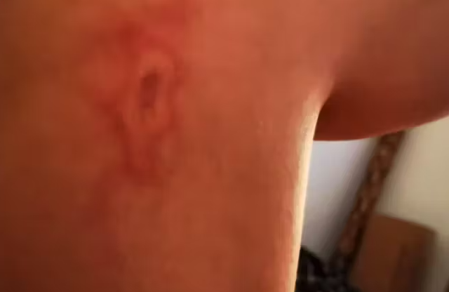 Ce a pățit o tânără din Elveția care a adormit pe încărcătorul de telefon băgat în priză: „Îmi voi face un tatuaj”. Imagini care vă pot afecta emoțional