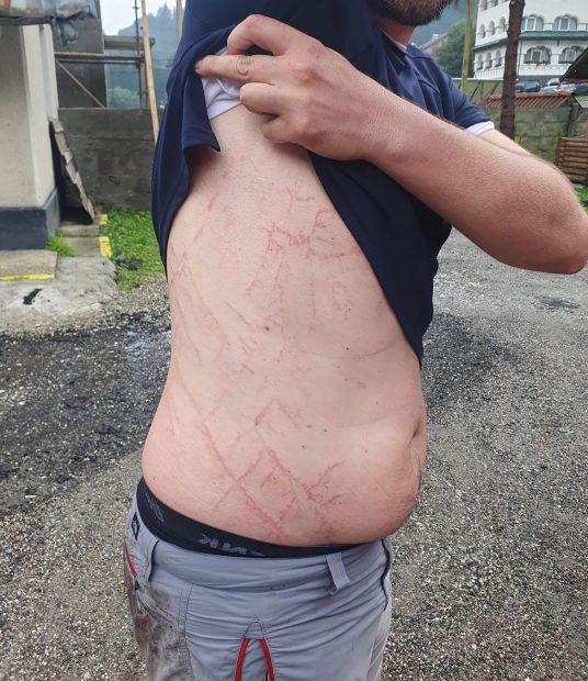 FOTO. Semnele lăsate pe corpul unui om de un fulger care a lovit în apropierea acestuia. Sfaturile salvamontiştilor