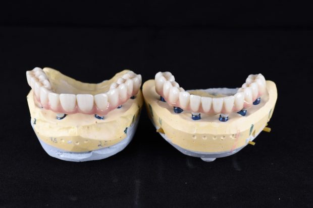 Ce înseamnă dantura fixă pe implanturi și cum te poate ajuta Ilieș Dental Clinic