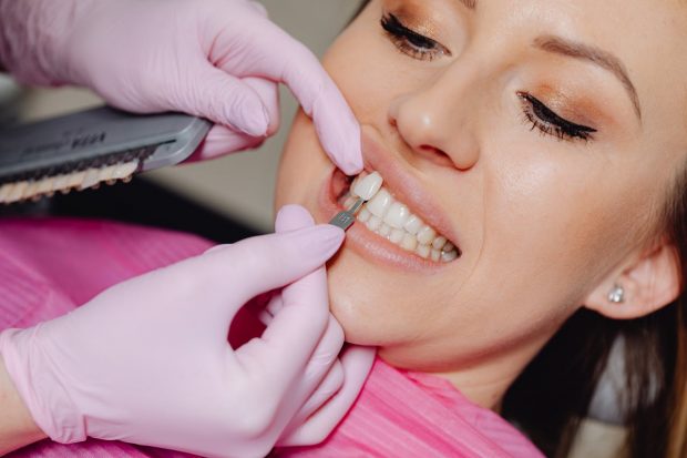 Cum să alegi nuanța potrivită pentru fațetele dentare