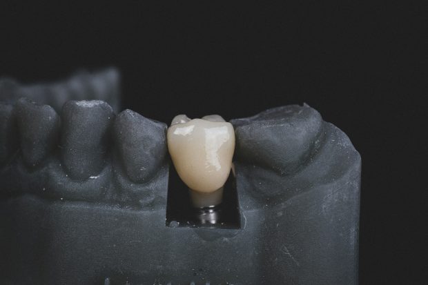 Totul despre îngrijirea după implant dentar: Sfaturi și Recomandări