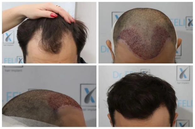 Ghid complet pentru îngrijirea părului după implant: Sfaturi și trucuri