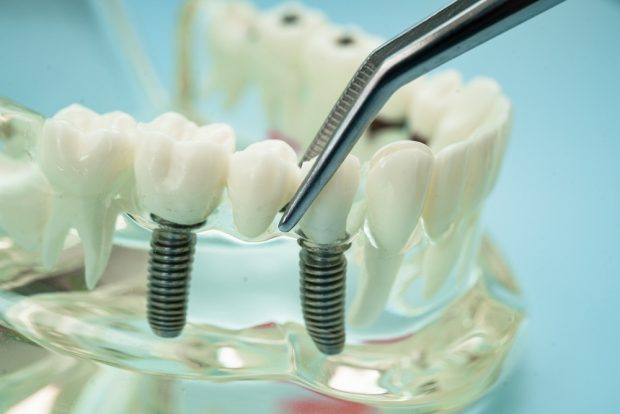 Avantajele implanturilor dentare: O soluție durabilă pentru un zâmbet sănătos