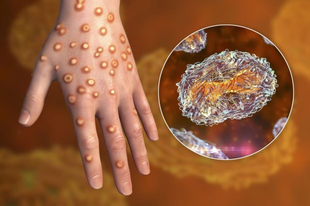 Primul caz de infectare cu noua variantă a virusului mpox, variola maimuței, confirmat în Germania