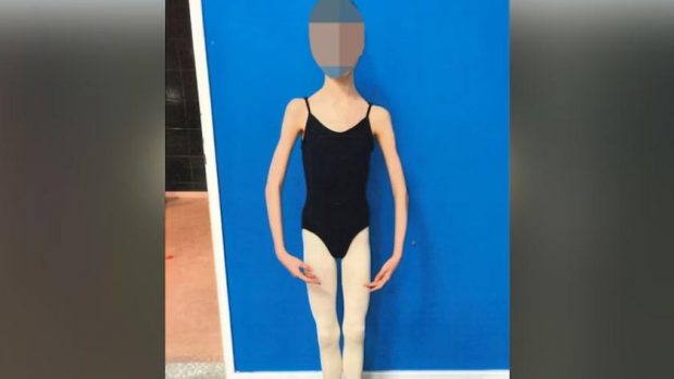 Doi părinți și-au înfometat fiica pentru că doreau să rămână mică. Fata de 17 ani ajunsese să cântărească 27,3 kilograme