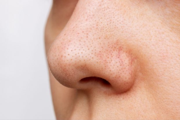 Cum să reduci apariția punctelor negre sau comedoanelor: sfaturi de la dermatologi