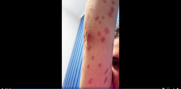 O studentă cazată într-un cămin din Regie a ajuns la spital cu zeci de înţepături pe corp: „Că-s nespălate şi vin de la ţară cu ploşniţele în raniţe”