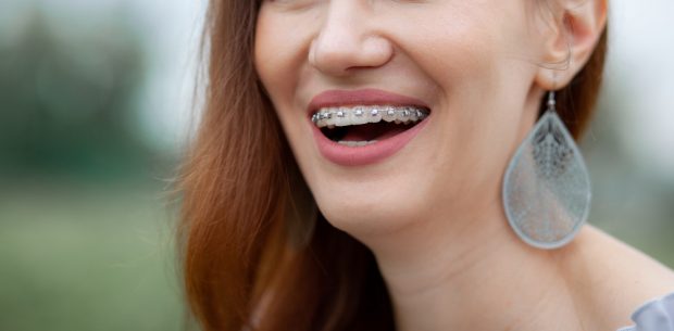 Cât de eficientă este purtarea unui aparat dentar la adulți?