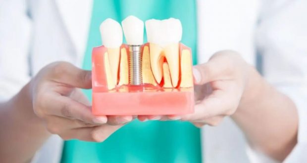 Cât costă o proteză fixă cu 4 sau 6 implanturi? Tot ce trebuie să știi despre această soluție modernă de reconstrucție dentară