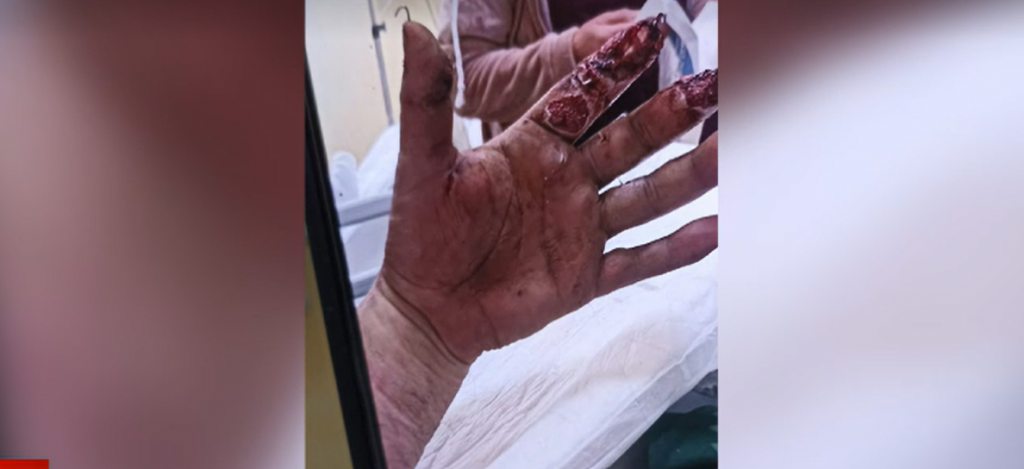 Avertismentul medicilor din Cluj înainte de Revelion. Cum arată mâna unui bărbat distrusă de o petardă