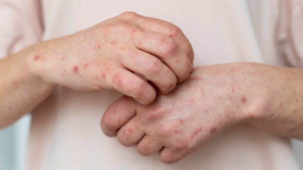 Noua variantă de Mpox a ajuns în Franța: „Acest lucru necesită vigilență și prudență”