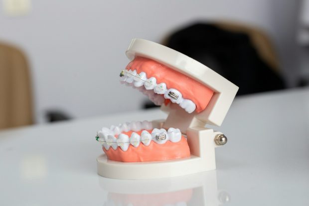 Cât costă un aparat dentar și cum alegi varianta potrivită pentru tine