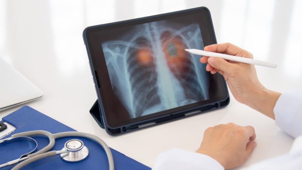 Cancerul pulmonar, din ce în ce mai frecvent printre nefumători. „Poluarea aerului, un factor important”