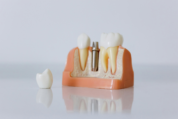 Știi că există modalitatea de implant dentar all on 6 în Suceava? Află amănunte în acest articol
