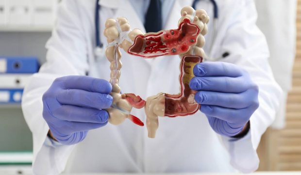  Secretul pentru o Protecție Naturală împotriva Cancerului de Colon - Recomandările Cruciale ale Oncologului. Prof. Stebbing explică efectul bifidobacterium și calciului din iaurt în prevenirea cancerului colorectal în creștere la tineri.