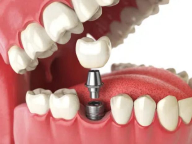 Cât costă un tratament cu implanturi dentare pentru toată gura?