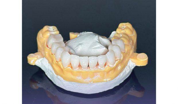 Implant dentar într-o zi? Află dacă ești candidatul ideal