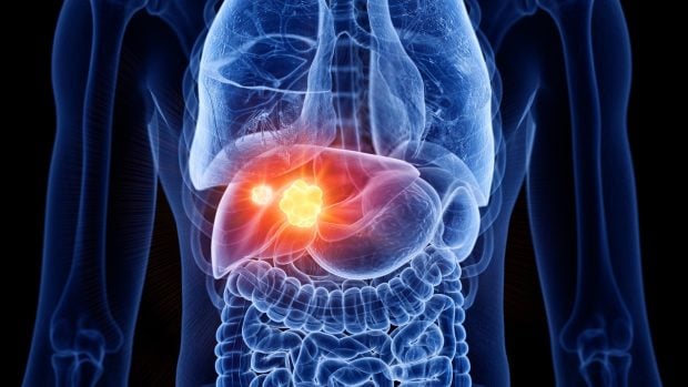 Cazurile de cancer hepatic aproape că se vor dubla la nivel mondial până în 2050