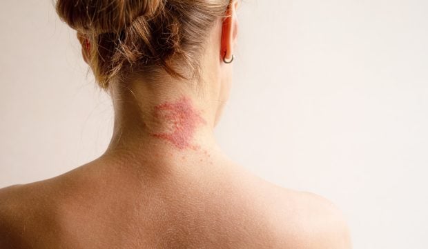 Dermatita este o boală contagioasă? Iată cum o tratăm